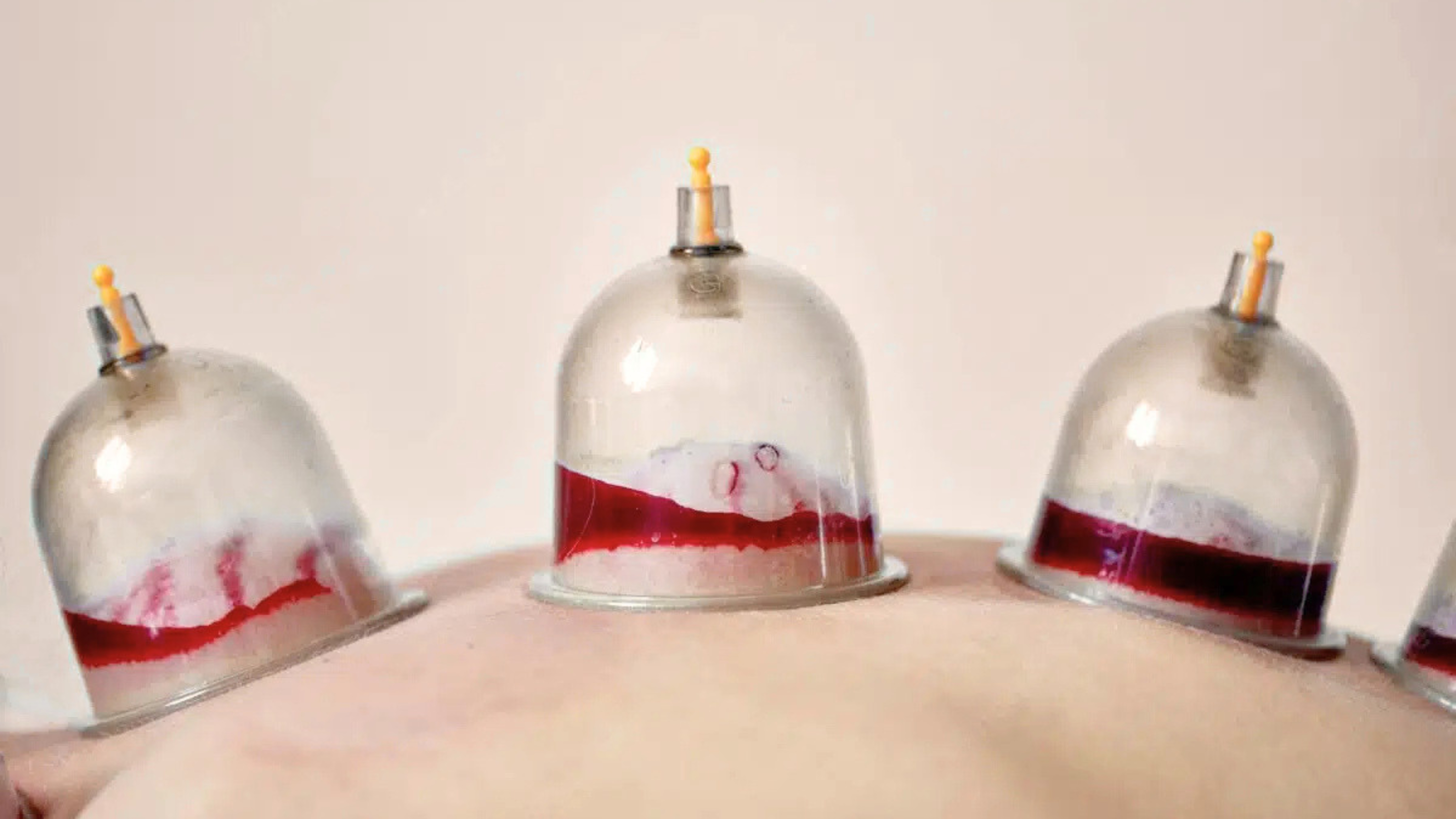 Hijama
