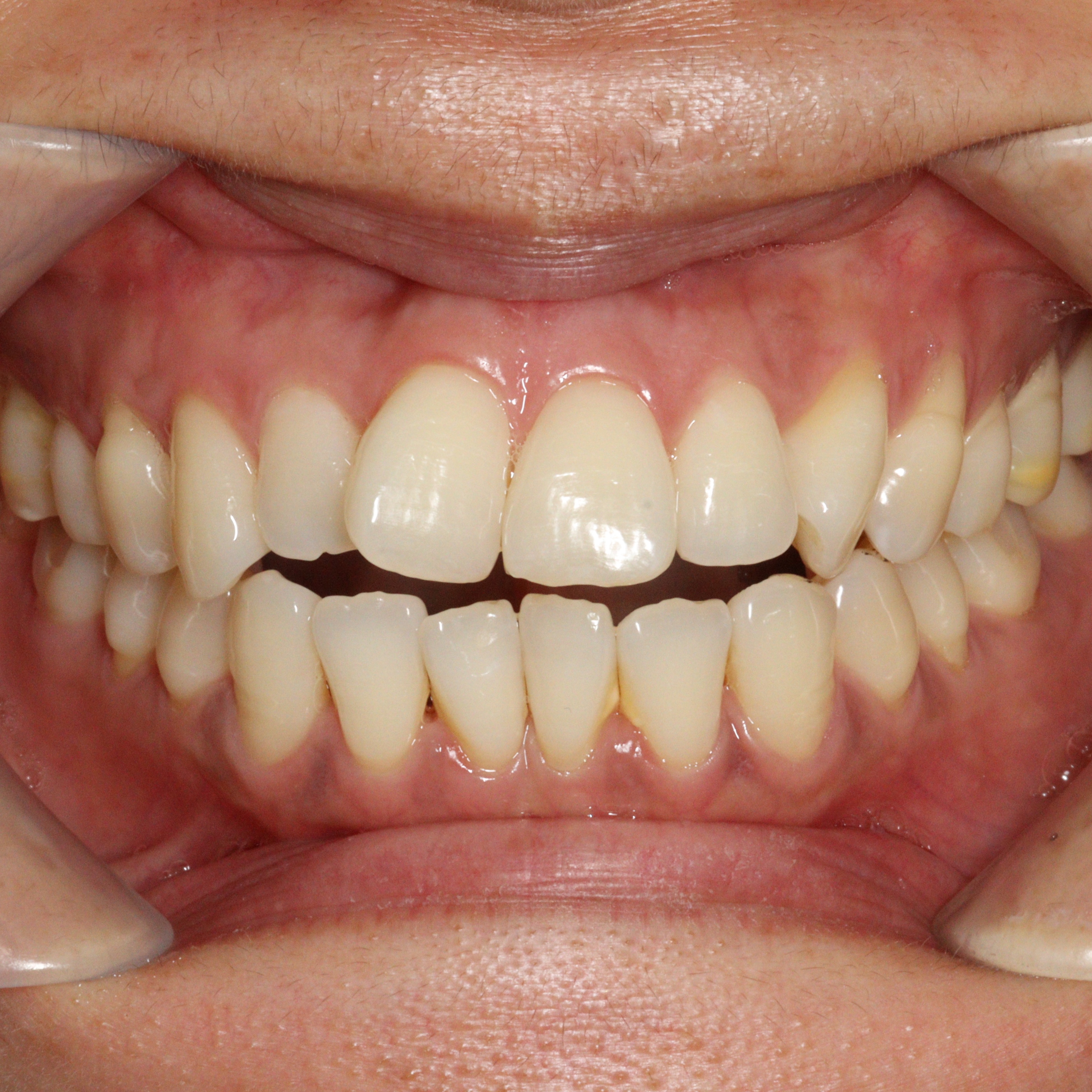  Invisalign Lite 