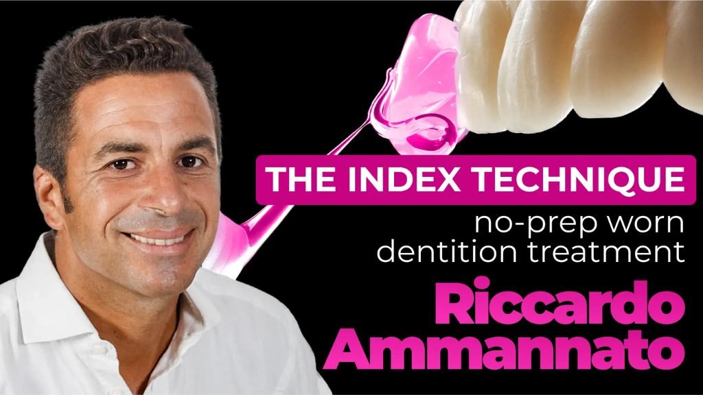 The Index Technique: No-Prep Worn Dentition Treatment