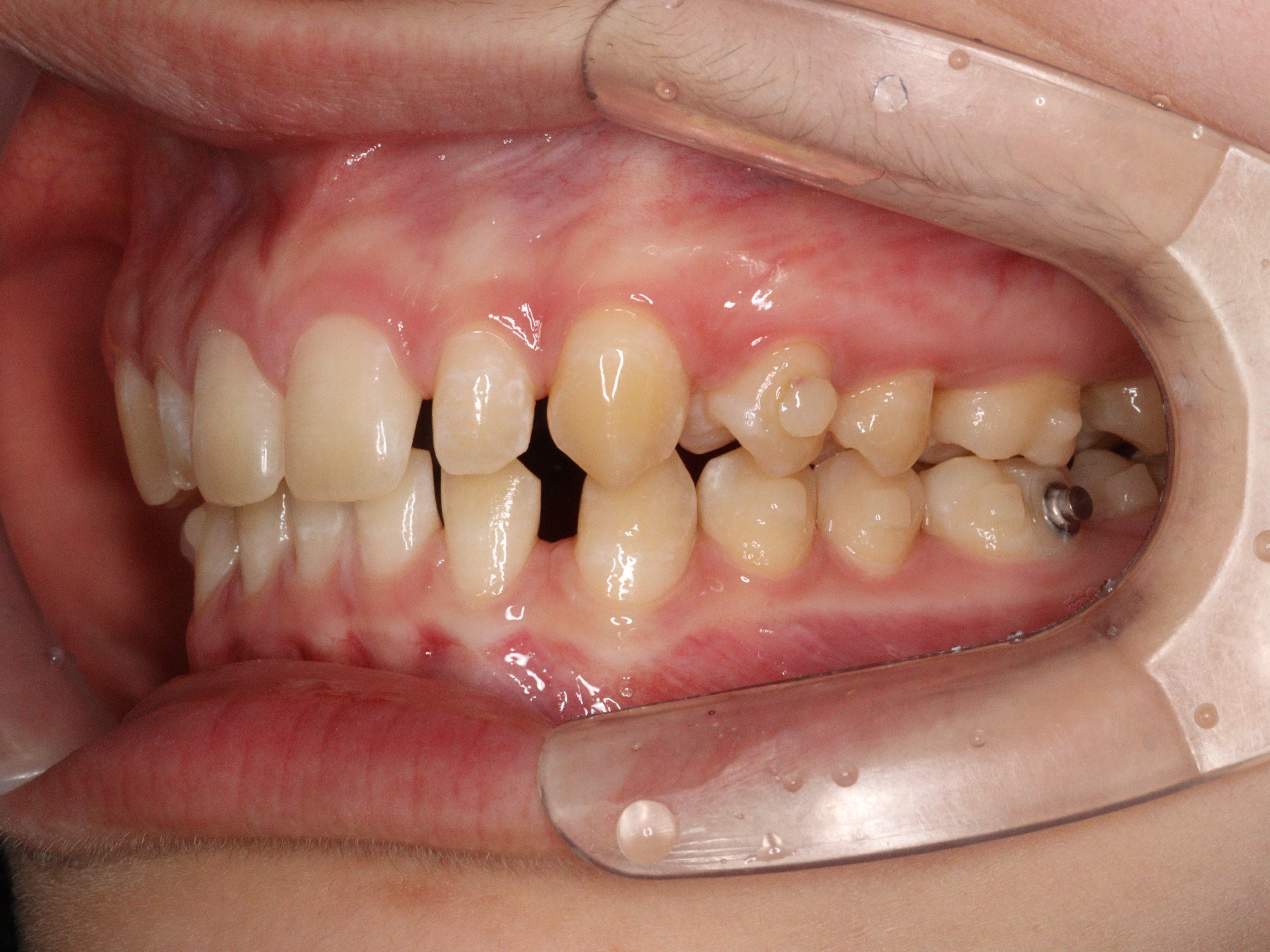 troubleshooting clearaligner