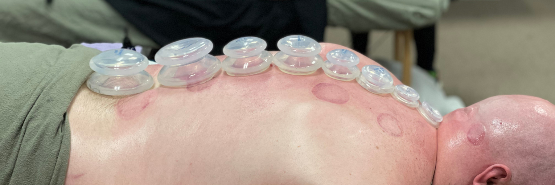 Massage Cupping Therapy