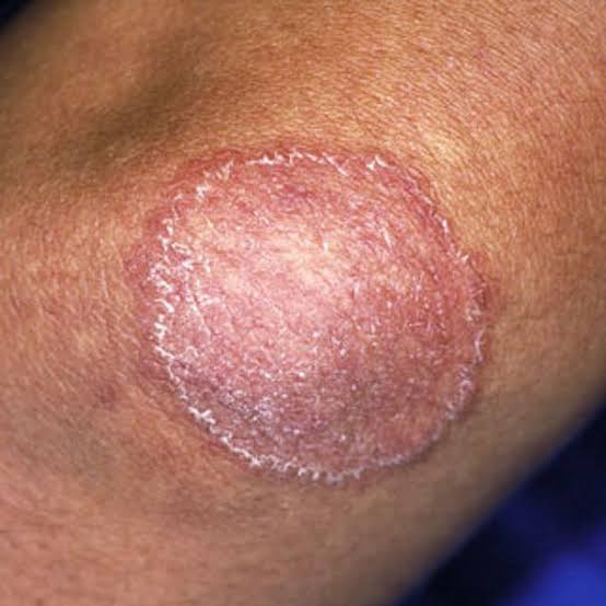 Product image for Scabies, Fungal Infections and Other Common Skin Infections in Senior Living Communities (1.0 Contact Hour)