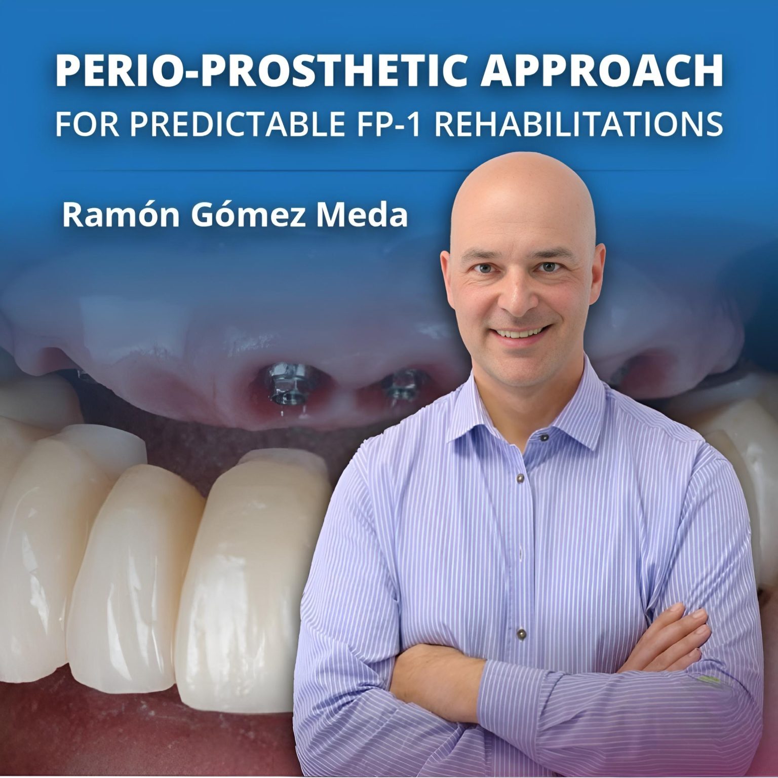 Product image for Perio-Prosthetic Approach for FP-1 Rehabilitations