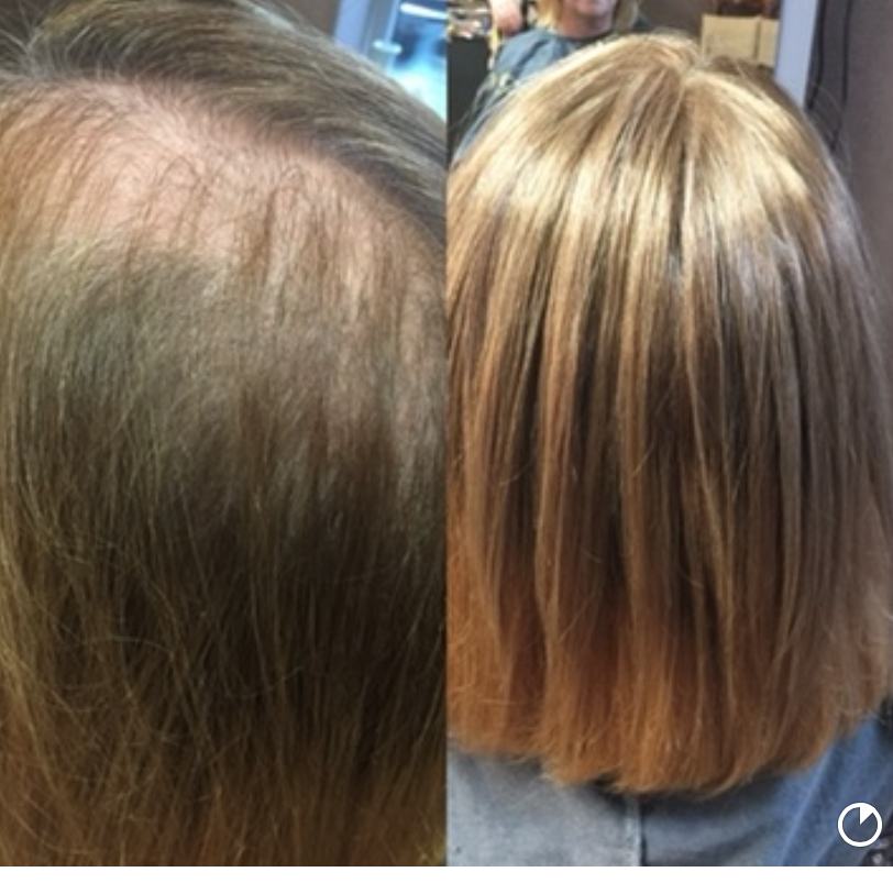 Product image for Step One : Hair Thinning Collection