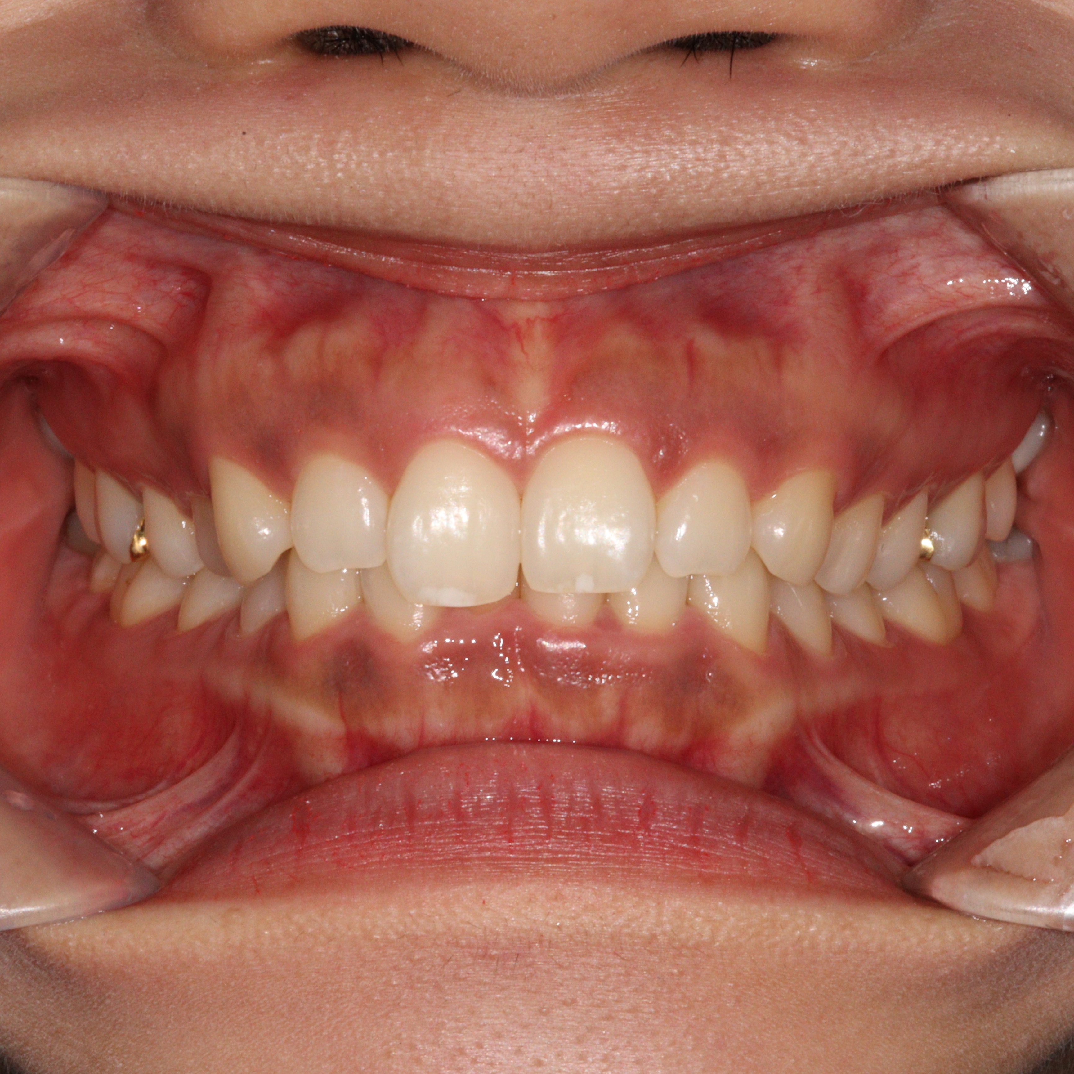  Invisalign Lite 