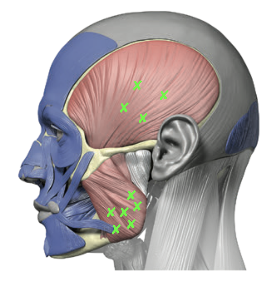 Product image for Therapeutic Uses of Botulinum Toxin