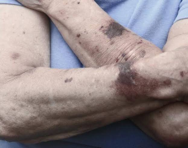 Product image for Recognizing Elder Abuse on the Skin (1.0 Contact Hour)