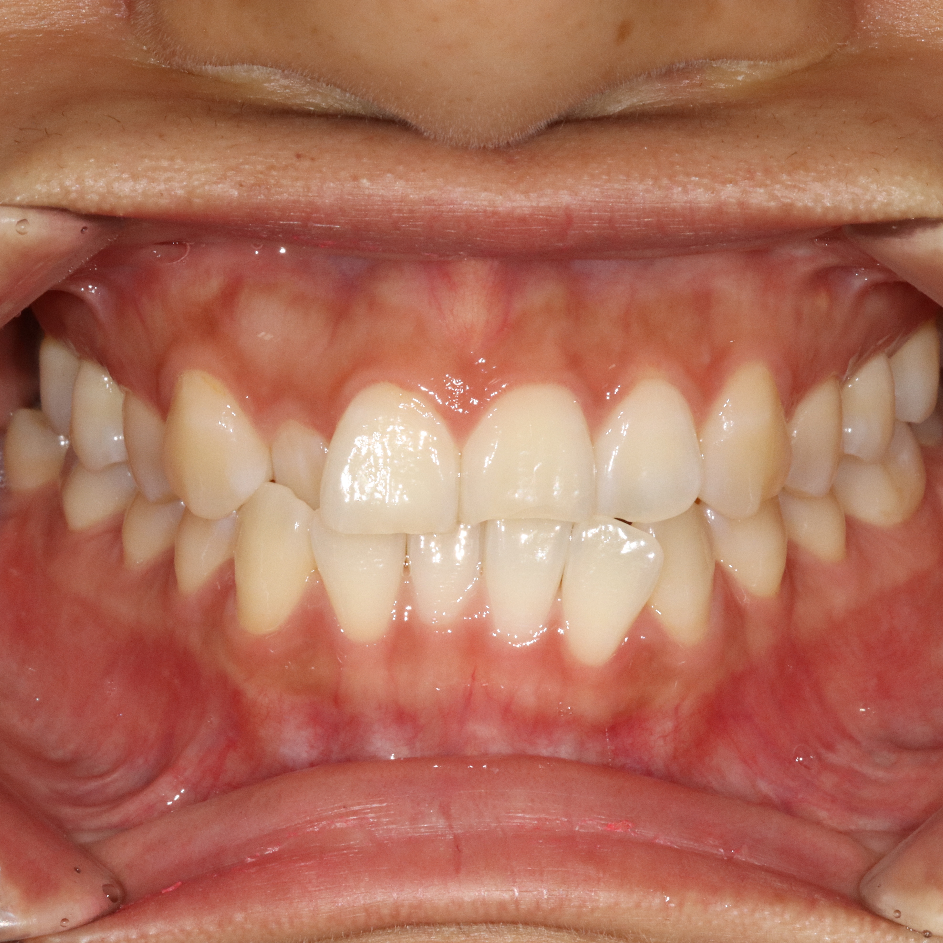 Invisalign Lite case