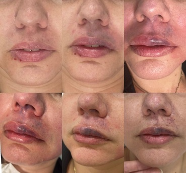 Product image for Qualifi Level 6 Award in Complication Management for Aesthetic Practice